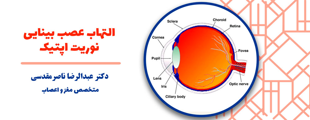درمان التهاب عصب چشم