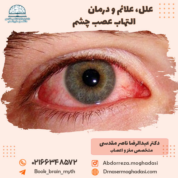 علل، علائم و درمان التهاب عصب چشم