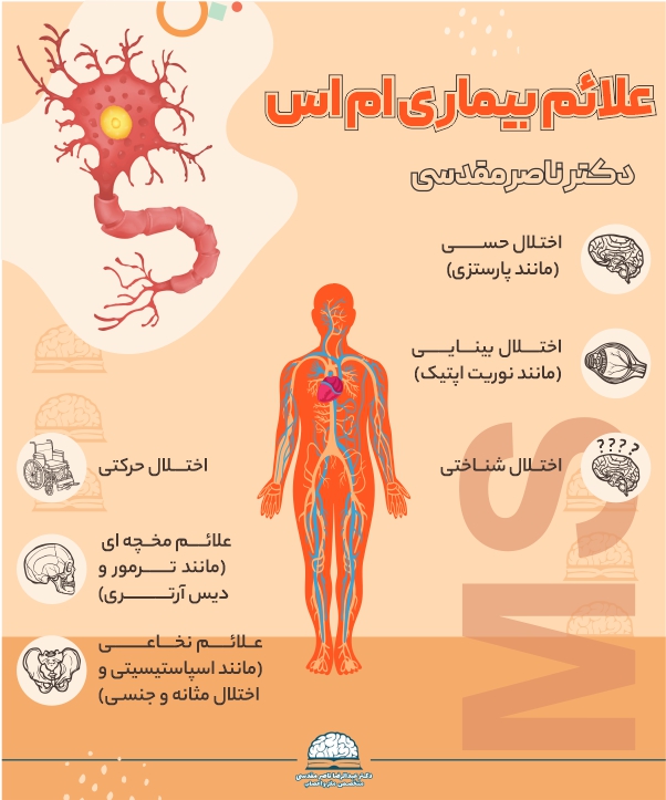 علائم بیماری ام اس