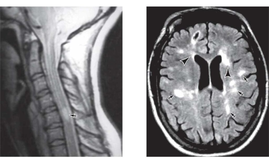 نقش MRI در تشخیص بیماری MS